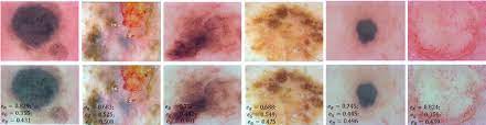 Prostate cancer is a common type of cancer in men, according to the mayo clinic. Color Constancy Examples Melanoma 1st 3rd Columns And Benign Download Scientific Diagram