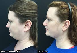 Amanda-Patrick-24-Weeks-Left-Side