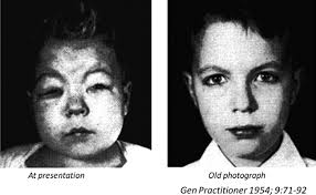 Minimal Change Disease: A CD80 podocytopathy?