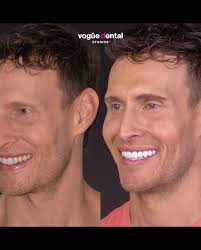 Notice anything different?! 😁 Zoom in 👀 I can't wipe the smile off my  face, and for good reason, after four years my smile makeover is complete.  In 2019 I finally decided