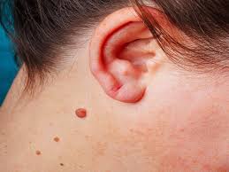 warts-removal-home-remedies-natural-treatment-hpv-skin-care-tips-hindi