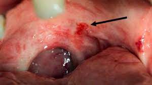 The medical term for numbness or tingling anywhere in the body is parasthesia. What Does Mouth Cancer Look Like 5 Pictures Of Mouth Cancer