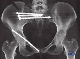In some cases, surgery is not needed. Orif Pubic Ramus Screw For Pubic Ramus Fractures