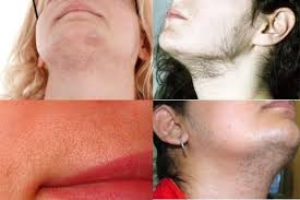 In laser chin hair removal, laser light pulses selectively destroy hair follicles by targeting the melanin in them. Laser Hair Removal Dermacore Telford Shrewsbury Shropshire Stafford