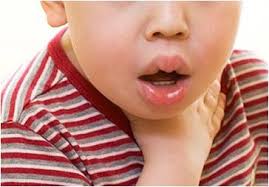 anaphylaxis ile ilgili görsel sonucu