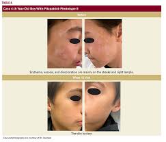 Image result for Atopic Patient