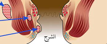 الخراج الشرجي اعراض اسباب وعلاج الخراج الشرجي ويب طب