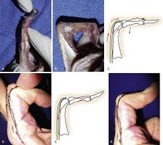 Image result for Elson Extensor Tendon Test