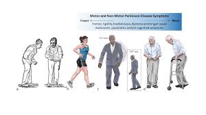 Parkinson's disease (pd) is the second most common degenerative neurological disorder after alzheimer's people with a close family member with parkinson's have a small increased risk (2. New Image Of Parkinson Disease Youtube