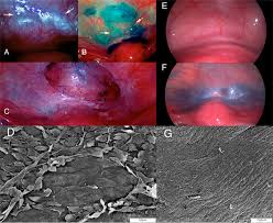 Endometriosis is a condition that occurs when tissue similar to the tissue that lines the uterus grows while physical examinations and ultrasounds can sometimes find endometriosis, a laparoscopy is. Intraoperative Detection Of Subtle Endometriosis A Novel Paradigm For Detection And Treatment Of Pelvic Pain Associated With The Loss Of Peritoneal Integrity Protocol