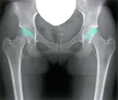In the early stages of avascular necrosis, symptoms might be eased with medication and therapy. Osteonecrosis Of The Femoral Head Amboss