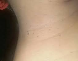 Verrugas En Pezones Club De Bebes Mayo 2018 Babycenter