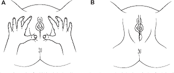 Image result for Labial Fusion