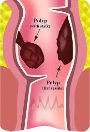 Image result for Colonic Polyp