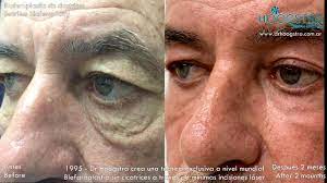 Cirurgia Palpebral Blefaroplastia A Laser Operacao De Palpebras Caidas Buenos Aires Hoogstra