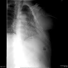 Image result for Flail Chest