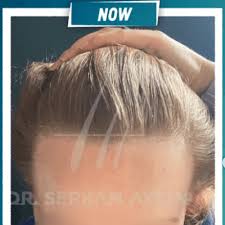 Il trapianto di capelli è l'operazione estetica più fatta dagli uomini. Trapianto Di Capelli Nelle Donne Foto E Testimonianze 2021