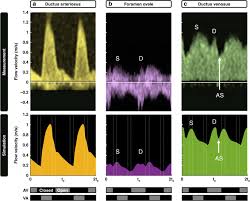Image result for Delayed Transition from Fetal Circulation