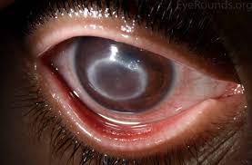Image result for Keratitis