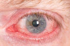 Image result for Scleritis