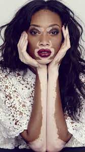 Check spelling or type a new query. Vitiligo Beauty Fashion Beauty Chantelle Brown Young