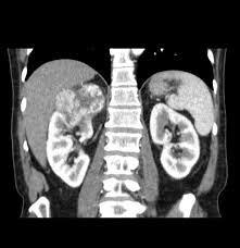 Renal Cell Carcinoma Radiology Case Radiopaedia Org Renal Cell Carcinoma Radiology Radiology Imaging