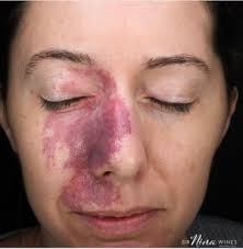 Birthmark — Northern Sydney Dermatology & Laser