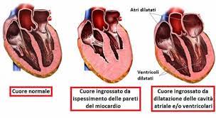 Anche se è vero che in molti casi resta asintomatica (priva di sintomi) la miocardite può interessare soggetti di qualsiasi età; Cuore Ingrossato Cardiomegalia