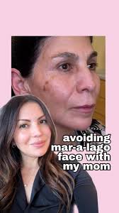 how we inject mom (not mar-a-lago), #okcinjector #okcmedspa  #facialbalancing #injectables #medspalife #okcbeauty #vanityfair