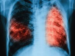 Tulang adalah jaringan yang terususun dari sel yang didominasi oleh matrix kolagen ekstraseluler atau yang bisa juga disebut osteoid. Apa Itu Tb Paru Rumah Sakit Kasih Ibu Surakarta