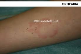 Alimenti, farmaci, punture o morsi di insetti. Cosa Fare Se Un Bambino Ha Una Reazione Allergica Myskin Dermatologi Online