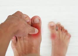 Image result for gout symptoms toe