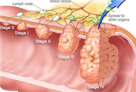 Bowel cancer is the third leading cause of cancer in the u.s. Colon Cancer Symptoms Survival Rate Treatment Stages