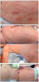 Your doctor will likely ask you to apply the medication to your whole body, from the neck down, and leave the medication on for at least eight to 10 hours. Scabies In An Infant Infectious Diseases