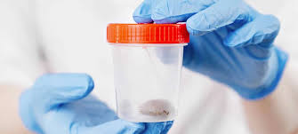 Image result for Stool Culture