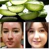 Aloe Vera For Face Pimples