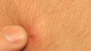 Causes of ingrown hair and genital warts. Ingrown Hair Philadelphia Pa Main Line Pa Farber Dermatology