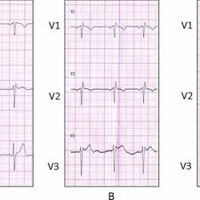 A Standard 12 Lead Ecg 4th Ics Leads V1 V3 Sinus Rhythm Heart Download Scientific Diagram