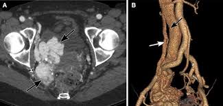Several terms are used in referring to malignant tumors: Ovarian Cancer Mimics How To Avoid Being Fooled By Extraovarian Pelvic Masses Springerlink
