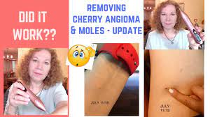Cherry angiomas aren't dangerous, so there's no medical reason to remove them. Burning Off Cherry Angioma Skin Tags Removal Tool Update Did It Work Youtube