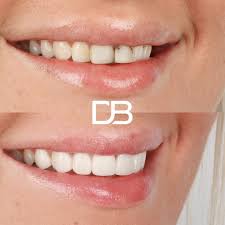 Primary treatment procedure: Porcelain Veneers. The after image was taken  approximately 1 week after the procedure. Please note that the outcome  shown in the image is only relevant for this patient and