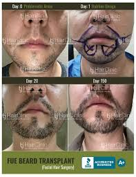 Facial hair transplantation is a surgical procedure that restores hair to areas of the face where hair is thin or missing. Beard Transplant In Mexico Tj Hair Clinic