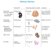 Image result for Calcium Nephrolithiasis