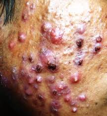 Image result for nodular acne