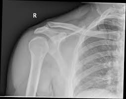 Posterior Shoulder Dislocation Radiology Case Radiopaedia Org Shoulder Dislocation Dislocation Bicep Tendonitis