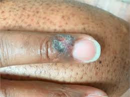 We did not find results for: Squamous Cell Carcinoma Mimicking Fungal Infection Sciencedirect