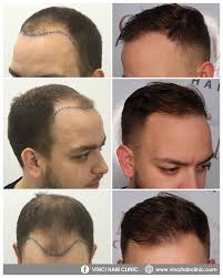 Mens Hair Loss Hair Loss Men Hair Transplant Procedure Hair Loss Solutions