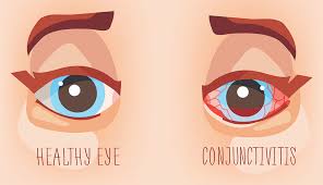 Image result for Conjunctivitis Resources