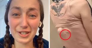 Có nốt ruồi lớn quá khổ trên người, cô gái trẻ mặc kệ bỏ qua, 3 năm sau mới  biết sự thật khủng khiếp đằng sau rồi qua đời trong ân hận