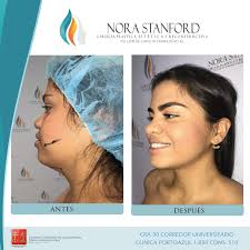 Dra. Nora Stanford MD على X: "Perfilamiento facial Agenda tu cita al  3114146505 📳@dranorastanford https://t.co/fnO4xmZp4k"